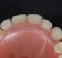 Неровные зубы повышают риск рака
