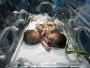 Сиамские близнецы родились с одним сердцем на двоих