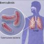 Кто находится в группе риска заболеть туберкулезом