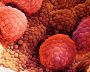 Выявлены антитела, уничтожающие рак простаты